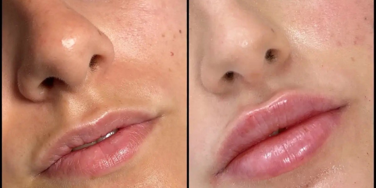 Personalized Fillers Solutions at Best Aesthetic Clinics in Dubai