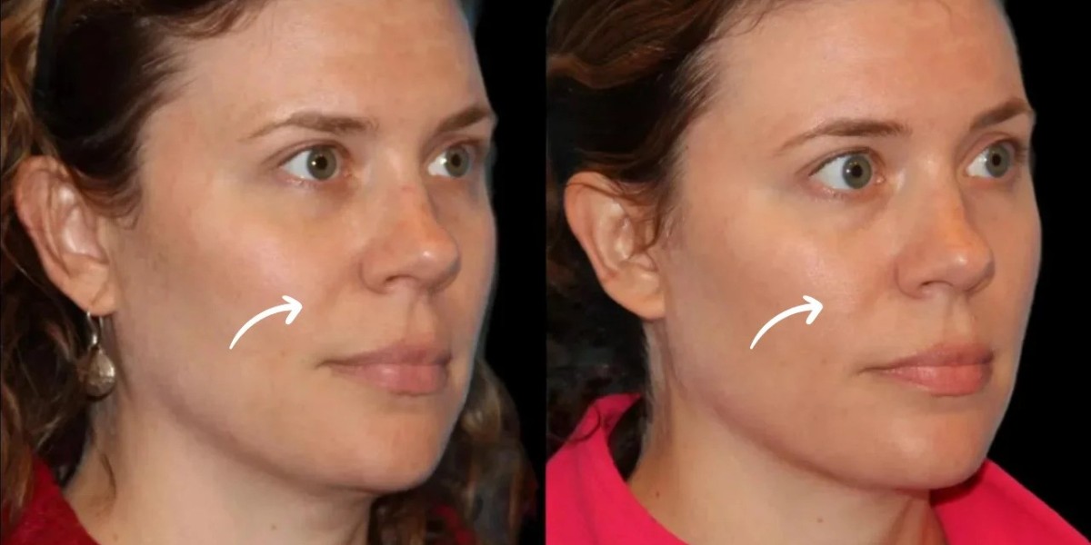 Best Aesthetic Clinics in Dubai for Sculptra Fillers Athletic Skin Texture