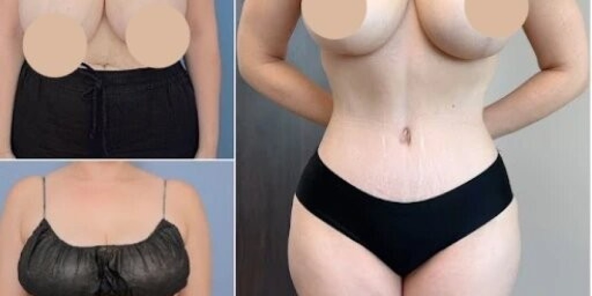 Best Doctors in Dubai for Tummy Tuck After Weight Loss