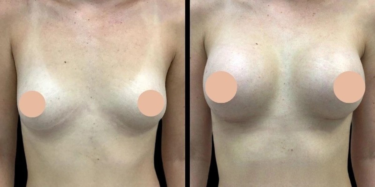 Breast Augmentation Consultation: Best Breast Augmentation Surgeons in Dubai
