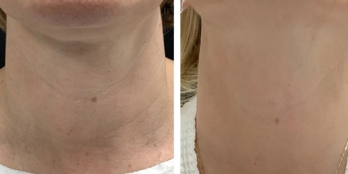 Best Doctors in dubai for Radiofrequency Microneedling Youthful-Looking Skin