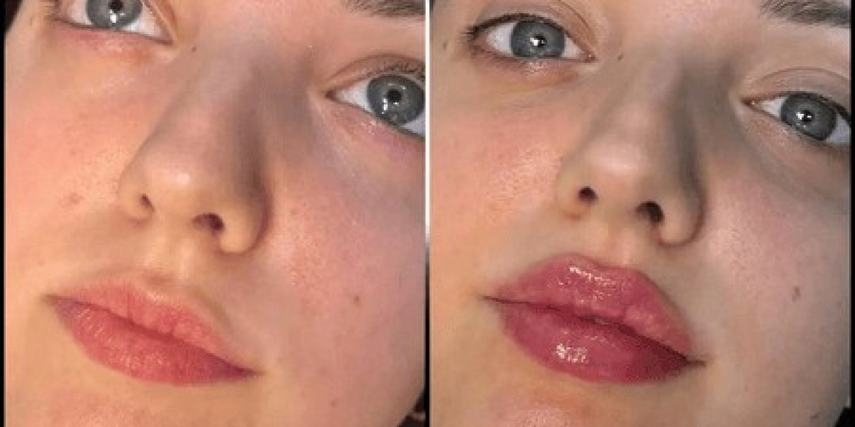 Best Plastic Surgeons in dubai: Restoring Facial Balance with Fillers