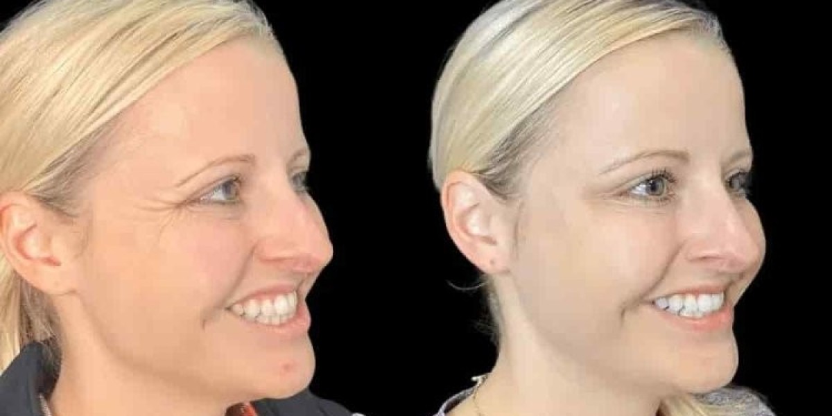 Best Aesthetic Clinic in Dubai for Botox: Understanding Your Treatment Goals