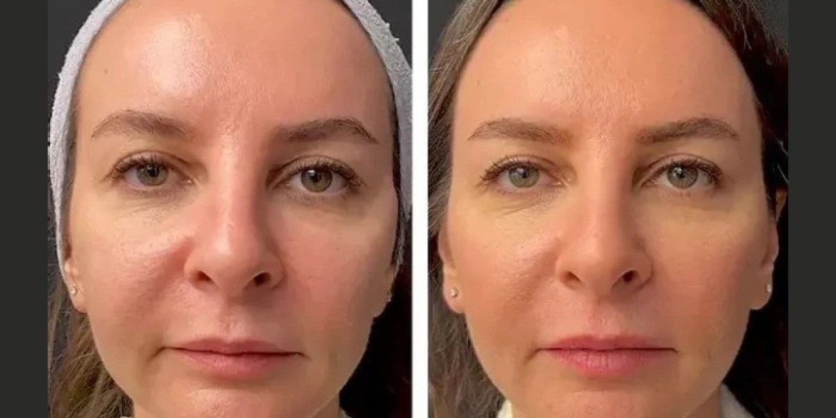 Best Plastic Surgeon in Dubai for Mesotherapy: Double Chin Reduction
