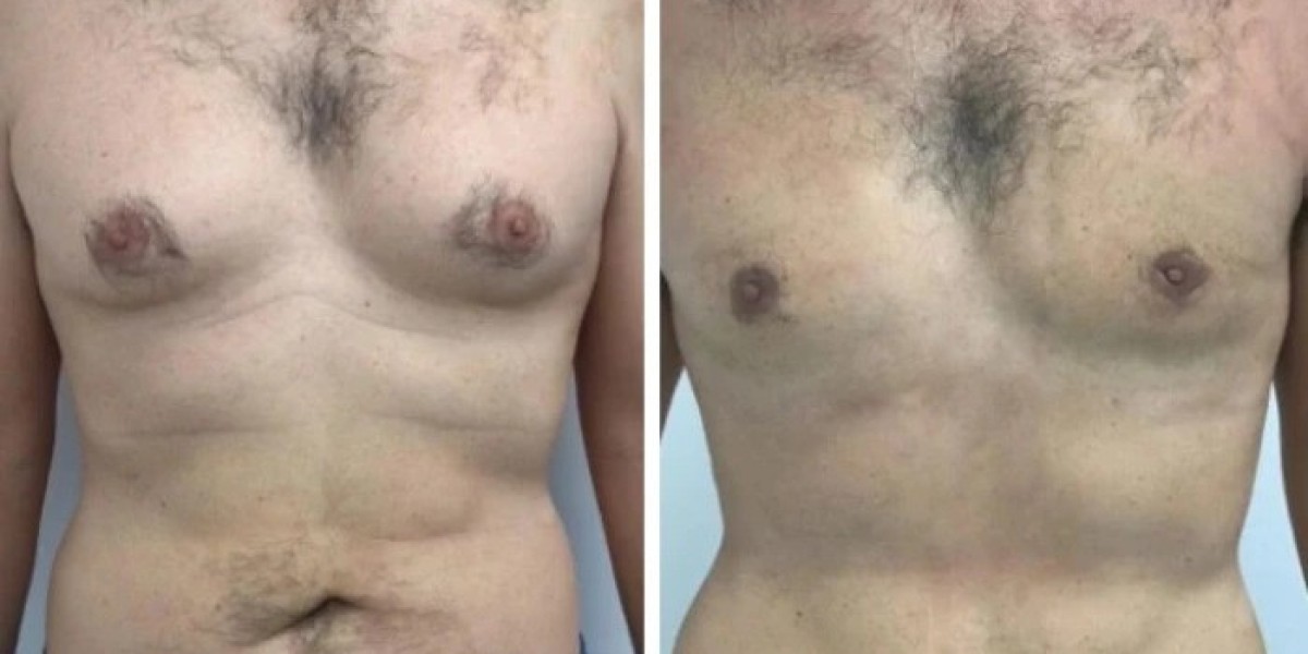 Best Gynecomastia Surgeons in dubai and Long-Term Chest Results