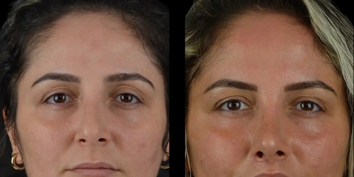 Professional Cheek Fillers Consultation in Best Aesthetic Clinics in Dubai