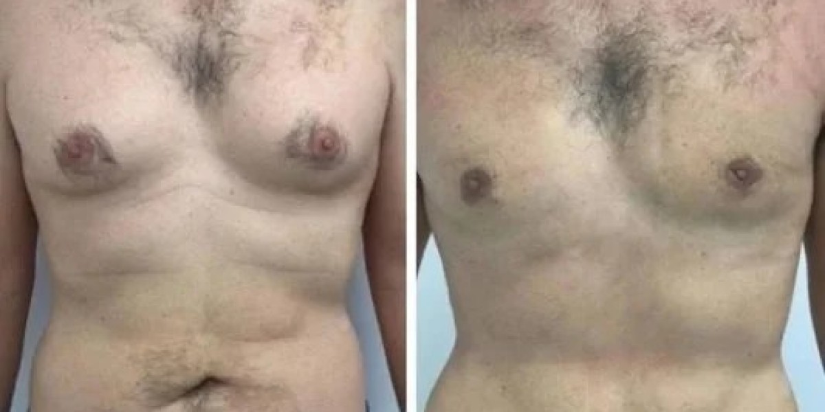Best Gynecomastia Surgeons in Dubai: Exploring Precision Treatment and Aftercare