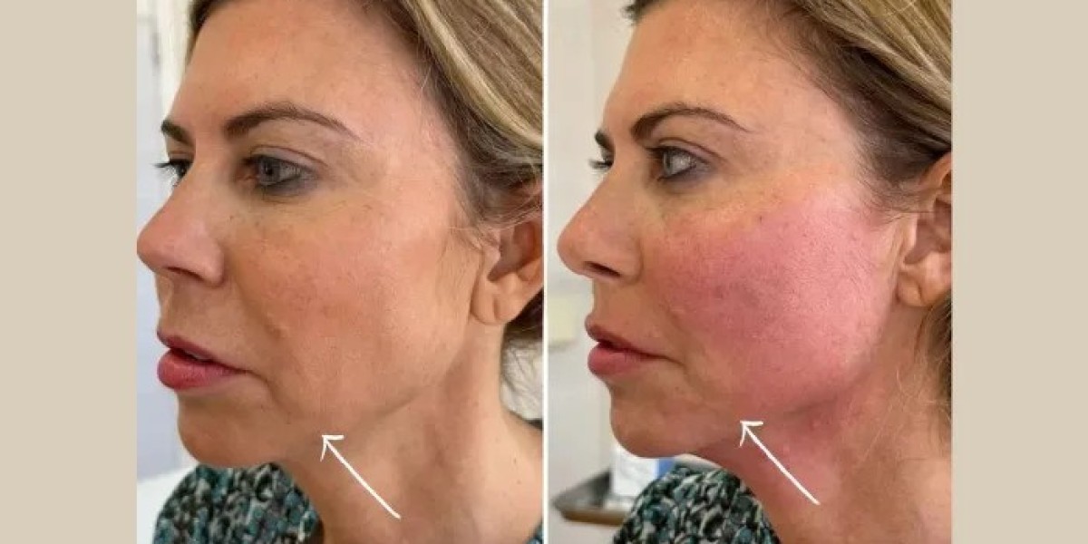 Endolift in dubai for Natural Looking Facial Rejuvenation Results