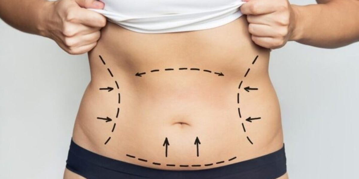 Best Doctors in Dubai for Liposuction: Advanced Body Sculpting Techniques