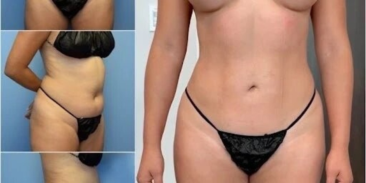 Best Body Contouring Surgeon in Dubai for Advanced Contouring and Sculpting