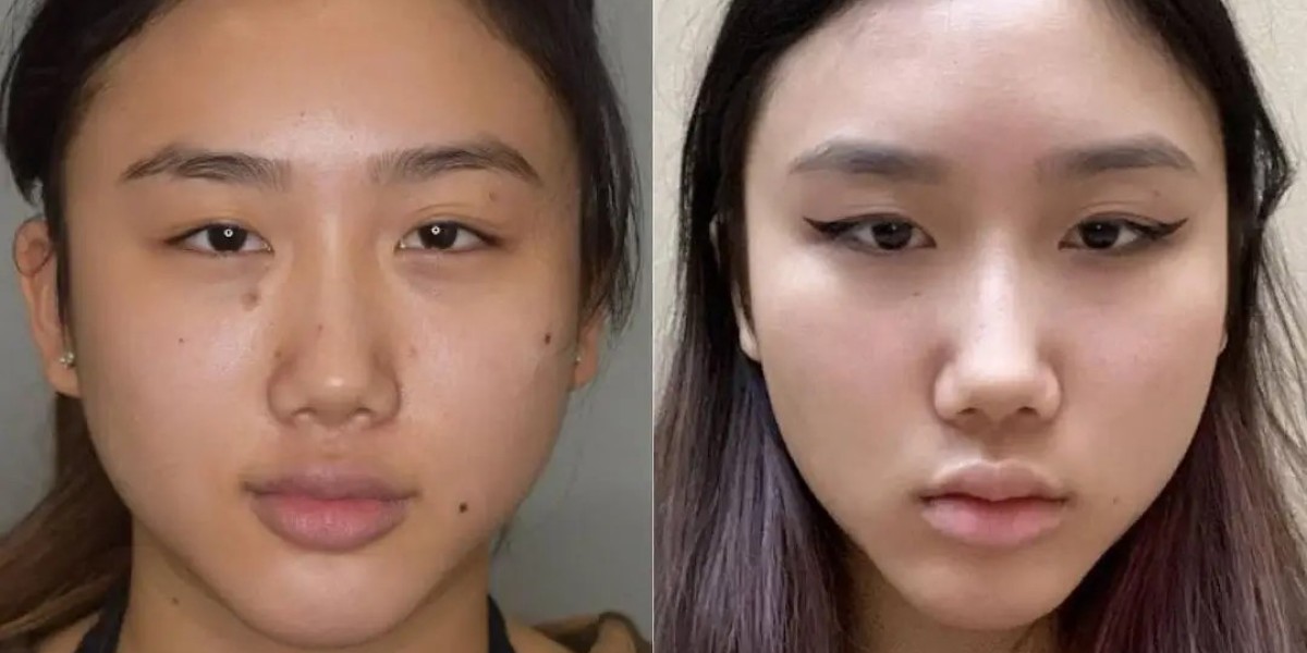 Best Buccal fat removal Surgeons in dubai achieve refined contours