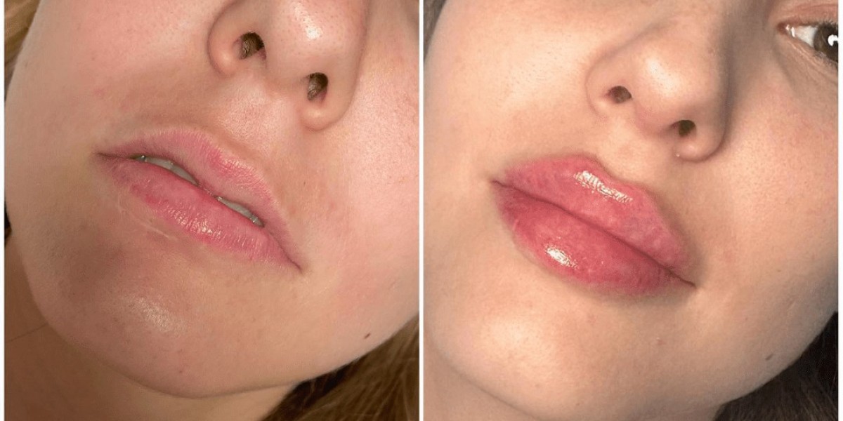 Juvederm Consultation Guide Best Plastic Surgeon in dubai